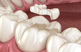 Animated smile during tooth colored filling placement