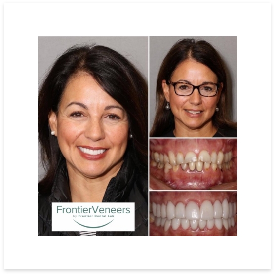 Woman's before and after smile after frontier veeners