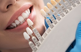 Woman's smile compared with porcelain veneer color chart