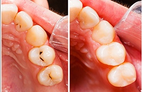 Teeth before and after receiving tooth-colored fillings in Milton