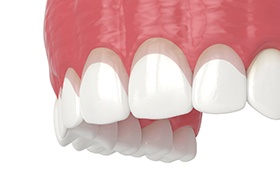 Illustration of teeth showing tissue to be removed via gum recontouring in Milton, MA