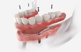 3D render of implant dentures