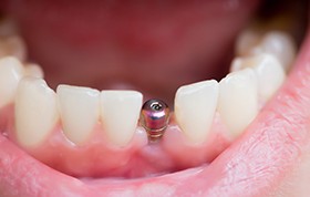 Smile with dental implant post visible