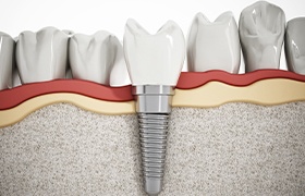 Animated dental implant supported dental crown