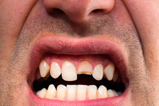 Close up of a man’s broken tooth