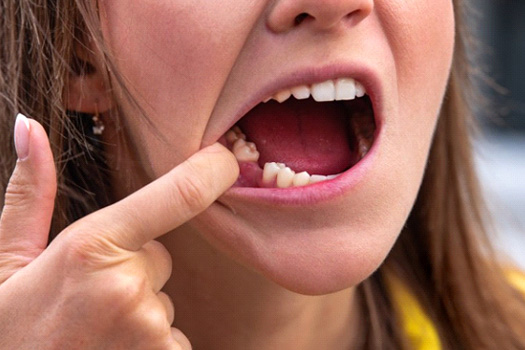 Woman pulling her lip back to reveal missing tooth