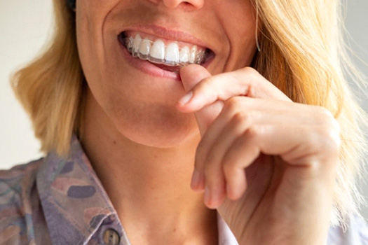 Woman putting on an upper arch Invisalign tray