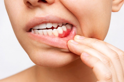 Close up of a woman’s bleeding gums