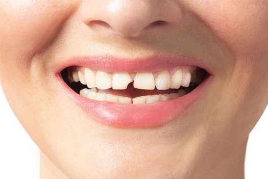 A woman with a broken tooth near East Milton
