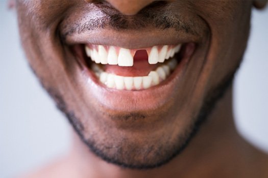 A man with a missing tooth near East Milton