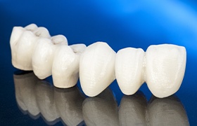 Dental bridge prior to placement