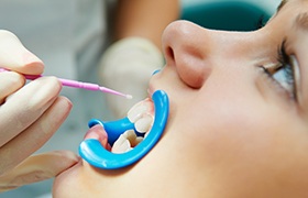 Young patient receiving fluoride treatment