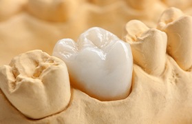 Model smile with dental crown restoration in place