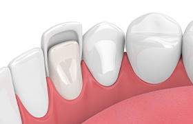 Animated porcelain veneer placement