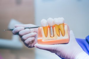 a dentist showing a replica of a dental implant