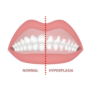 Illustration of mouth with one normal side and one side with overgrown gums